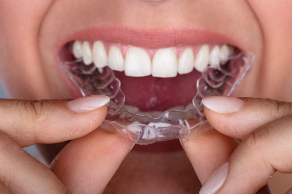 Clear Aligners